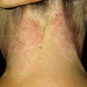 lichen-simplex-chronicus