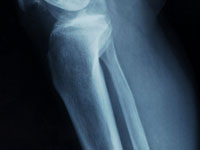 osteoporosis-bone-health