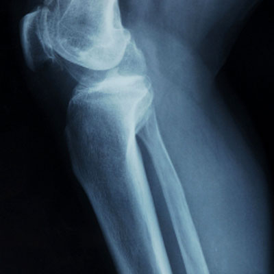 osteoporosis-bone-health