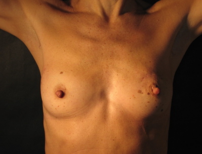 breast-cancer