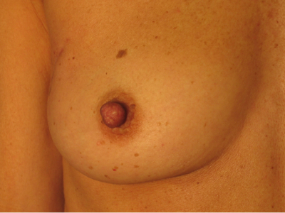 mastectomy