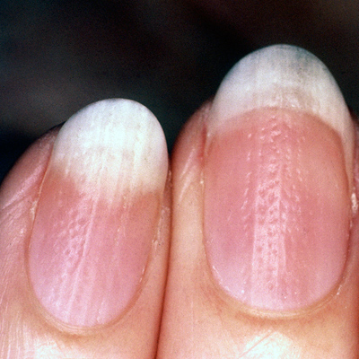 psoriasis toenail pictures