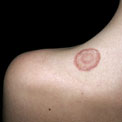 ring-worm