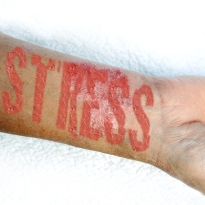 The psoriasis-stress connection. “There are some people for whom stress is 