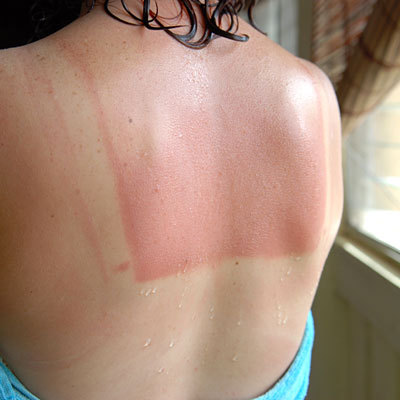 back-sunburn