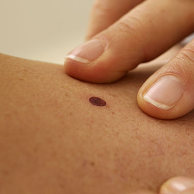 mole-signs-cancer