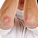 psoriasis-elbows