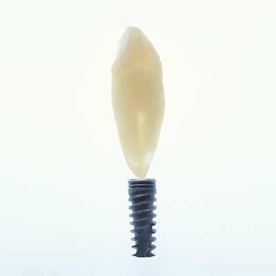 tooth-impant