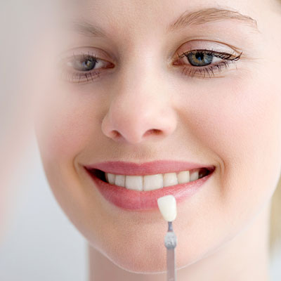 tooth-veneers