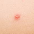 pimple-groin
