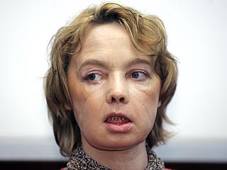 Face Transplant Patient Meets the Press