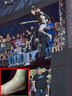 Pete Wentz Shows Off His Broken Ankle | Pete Wentz
