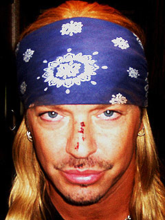 Bret Michaels Shows Off His Tonys Bruises