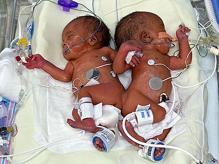 Formerly Conjoined Twins Healthy & Starting to Crawl| Health, Real People Stories