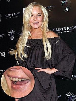 Lindsay Lohan's Teeth: What's Wrong with Them? | Lindsay Lohan
