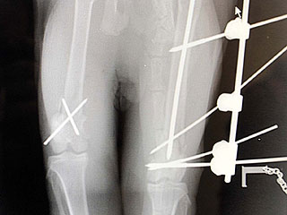 Me-Ouch! 'Bionic' Cat Survives Four-Story Fall | Cats