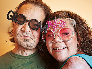 Face-Transplant Survivor Dallas Wiens Finds Love with Burn Survivor Jamie Nash