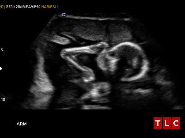 Derick and Jill Duggar Dillard Reveal Their Son's Ultrasound Picture| Babies, Reality TV, Derick Dillard, Jill Duggar, Jim Bob Duggar, Michelle Duggar