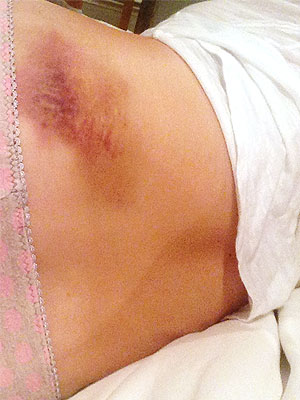 Candace Cameron Bure Shares Pics of 'Brutal' Bruises from DWTS Rehearsals| Dancing With the Stars, Candace Cameron, James Maslow, John Stamos, Lori Loughlin, Mark Ballas, Peta Murgatroyd