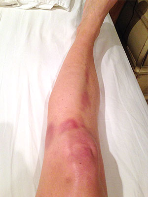 Candace Cameron Bure Shares Pics of 'Brutal' Bruises from DWTS Rehearsals| Dancing With the Stars, Candace Cameron, James Maslow, John Stamos, Lori Loughlin, Mark Ballas, Peta Murgatroyd