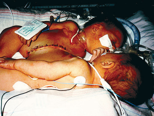 Once-Conjoined Twins Graduate at Top of Class, Heading to Separate Colleges| Real People Stories