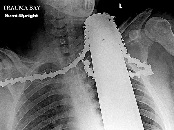 Pittsburgh Man Taken to Hospital with Chainsaw in Neck, Survives Emergency Surgery| Real People Stories