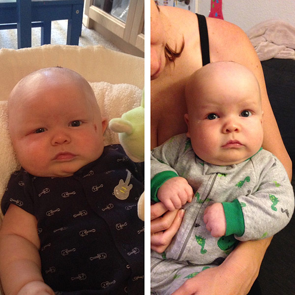 Texas Infant's Head Shape Reveals Craniosynostosis ...