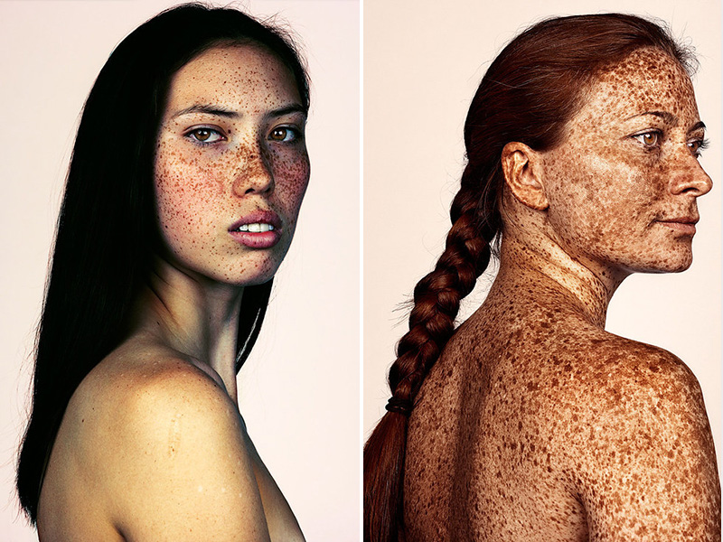 This Photo Series Proves Just How Beautiful Freckles Really Are| Bodywatch