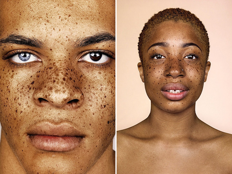This Photo Series Proves Just How Beautiful Freckles Really Are| Bodywatch