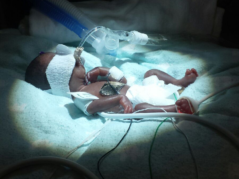 One of the Smallest Babies Ever Born (at Just 10 Ounces) Beats the Odds and Goes Home From Hospital| Babies, Real People Stories
