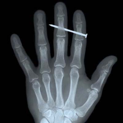 x-ray of hand with nail gun injury < >. Kaj R. Svensson/Photo Researchers