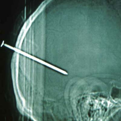 nail gun injury in back of skull