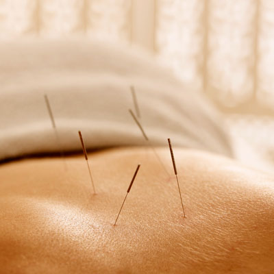 Acupuncture