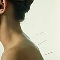 acupuncture-in-back