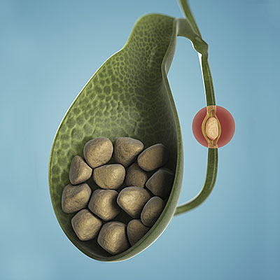 color of urine and stool gallstones