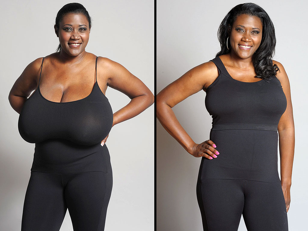 Woman Whose Bra Size Was 36N Gets A Life-changing Breast Reduction - Health  - Nigeria