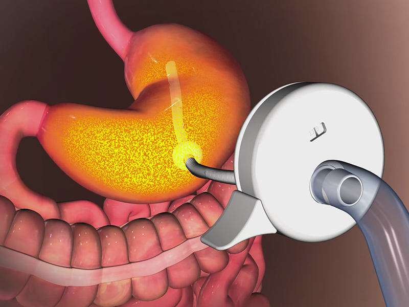 Weight Loss Stomach Pump Approved by FDA : People.com